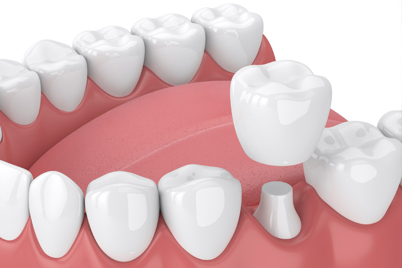 Dental Crowns in Suwanee