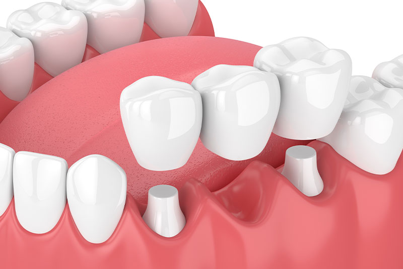 Dental Bridges in Suwanee