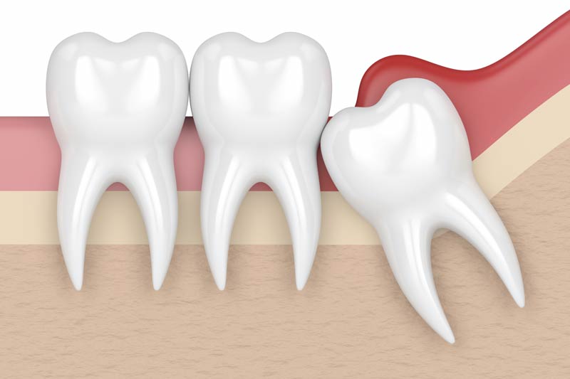 Wisdom Tooth Removal in Suwanee